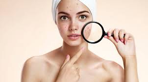 TRACTAMENTS ANTI-ACNÉ